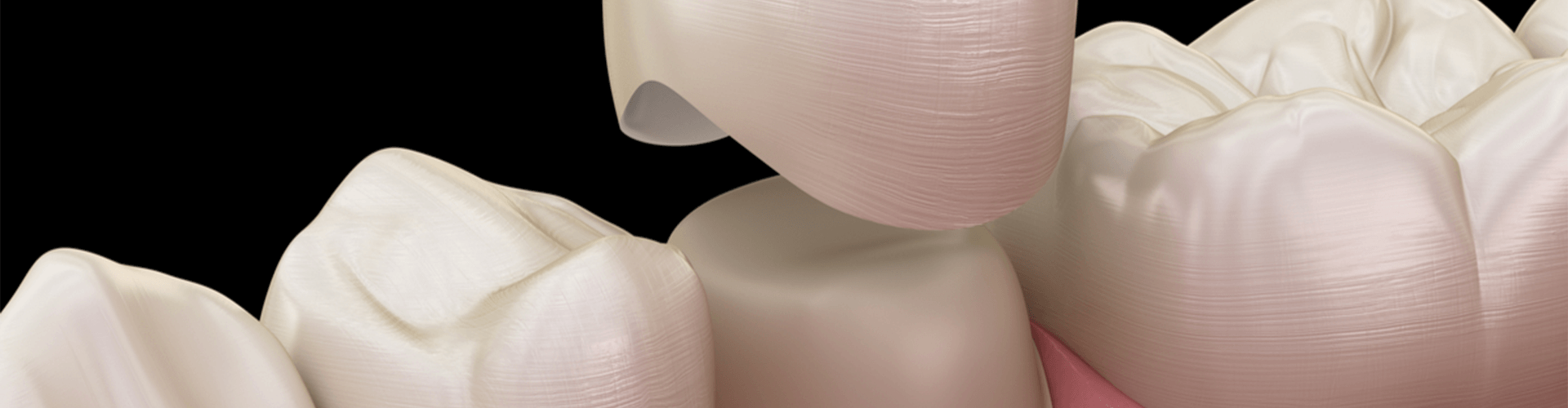 rendering of a porcelain tooth crown